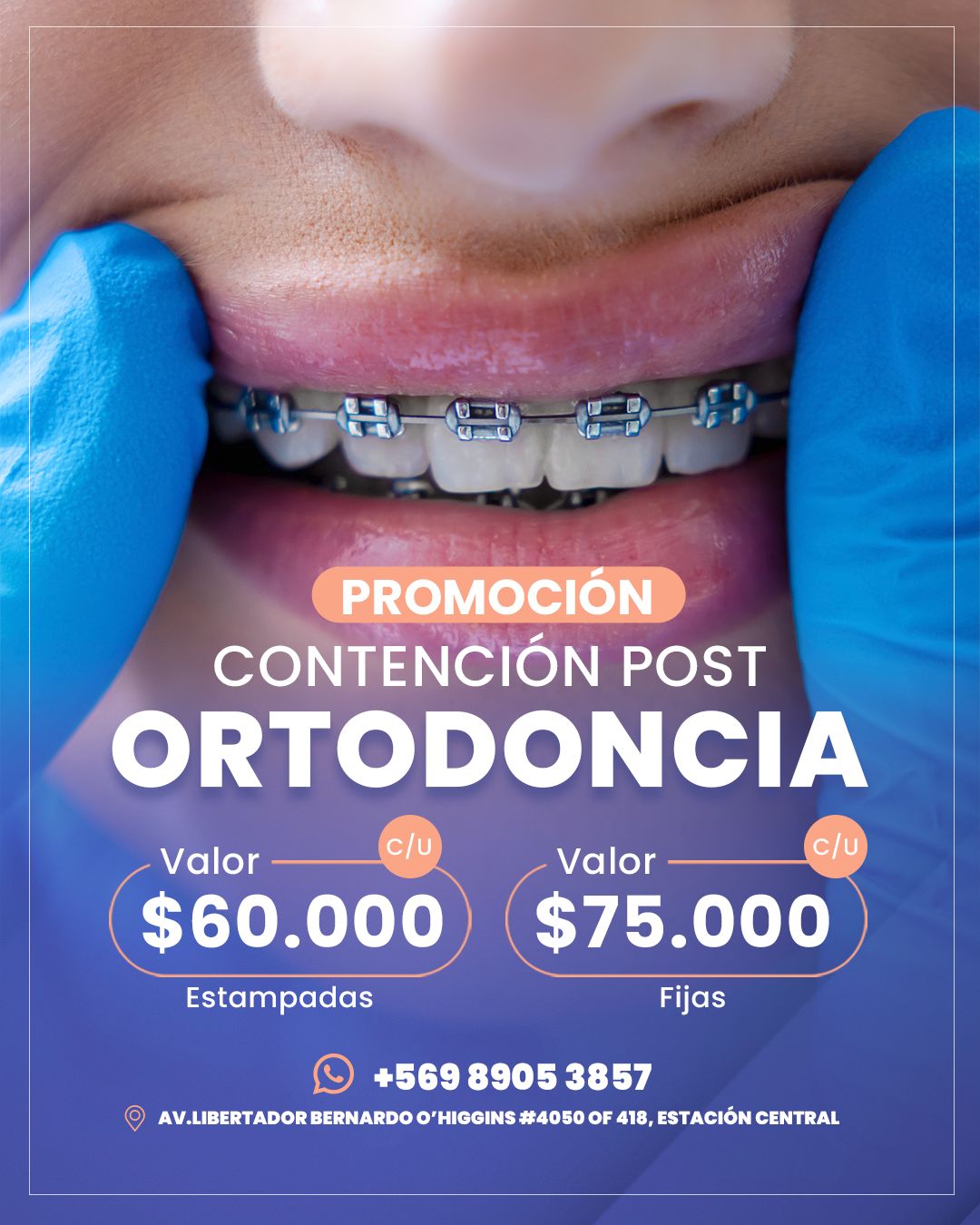 Contenciones dentales desde $60.000